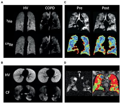 Functional lung imaging using novel and emerging MRI techniques